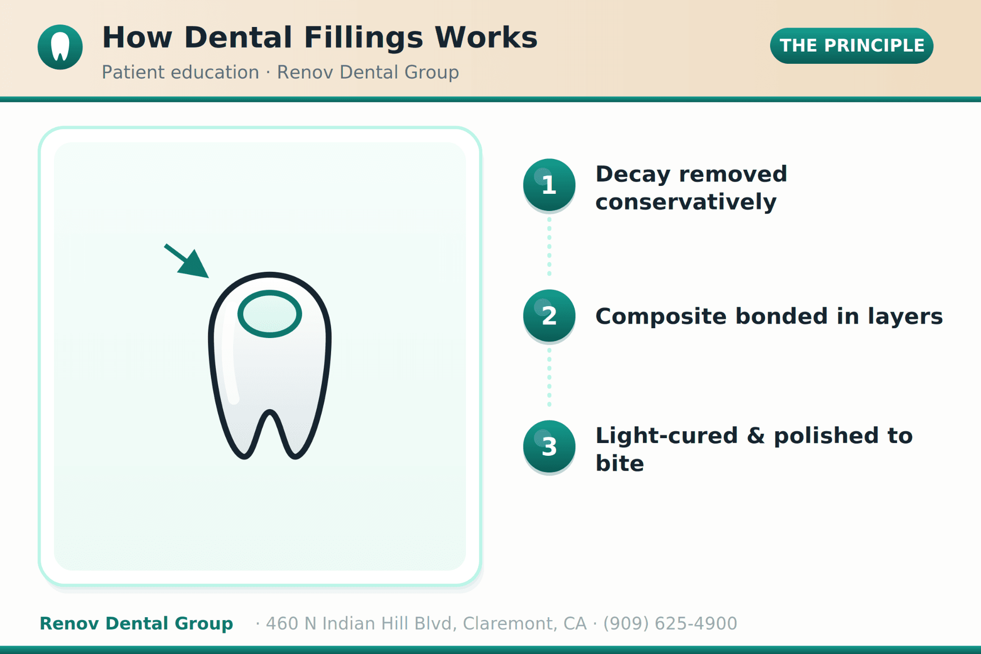 Dental Fillings in San Dimas